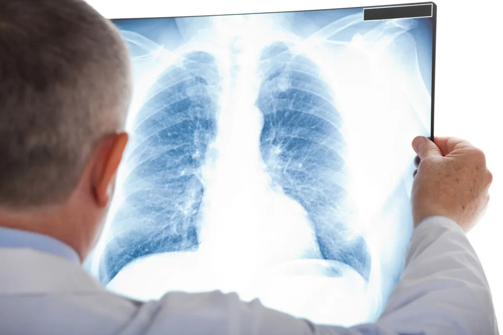 Doctor looking at x-ray of lungs. Mesothelioma Lawyer Baltimore Maryland